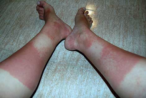 Piernas de Lydia, afectada por alergia por botas