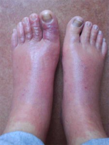 Los pies de Paqui, una de la afectadas por la alergia producida por las botas.