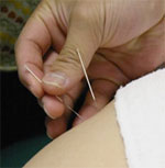 acupuntura