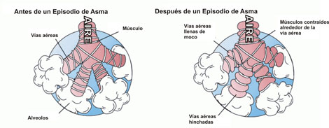 asma, diagrama asma, diagrama