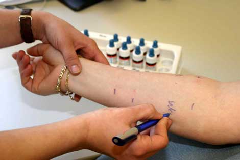 Prueba de alergia Prueba de alergia